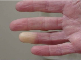 RUKE I NOGE SU VAM STALNO HLADNE, A NIJE CIRKULACIJA? Evo Od Čega Bolujte, ODMAH REAGUJTE!