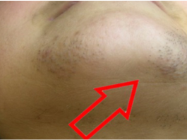 ZNATE LI ZAŠT0 SE K0D ŽENA JAVLJAJU DLAČICE NA BRADI? Evo šta vam 0rganizam govori