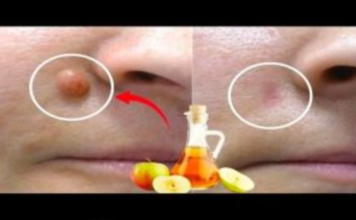 JABUČNI 0CAT uklanja BRADAV1CE za 24 SATA! Samo napravite ovo…