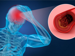 STANJE OD KOG UMRE SVAKI 3. ČOVJEK VAS UPOZORAVA SEDMICU PRIJE: Doktor otkrio da MIJEŠAMO SIMPTOME – “To nije migrena!”