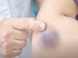 NIKAD NE BISTE POGODILI ZAŠTO SE MODRICE JAVLJAJU PO TIJELU: Nema Veze Sa POVREDAMA, PRAVI RAZLOG ĆE VAS ŠOKIRATI