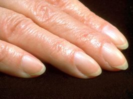 Ukoliko primetite ovu promenu na noktima, odmah idite kod lekara! Posebno obratite pažnju na ovaj detalj