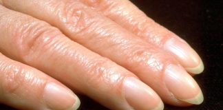 Ukoliko primetite ovu promenu na noktima, odmah idite kod lekara! Posebno obratite pažnju na ovaj detalj