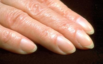 Ukoliko primetite ovu promenu na noktima, odmah idite kod lekara! Posebno obratite pažnju na ovaj detalj