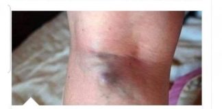 NAMIRNICE KOJE POVEĆAVAJU RIZIK OD TROMBOZE, JEDNA POSEBNO: Jedemo ih svakoga dana, a štete arterijama