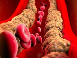 Ovi znaci na nogama pokazuju da imate izuzetno visok holesterol: Ne smijete ih ignorisati