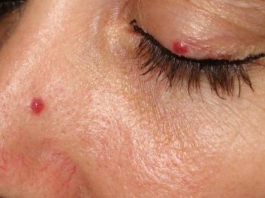 Na koži su vam se pojavili crveni madeži: Evo zbog čega nastaju i da li su opasni