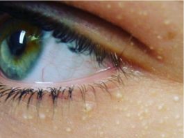 NI SLUČAJNO IH NE ISTISKUJTE, IMATE LI OVE BIJELE TAČKICE NA LICU? Uklanjaju se jednstavno, TREBAJU VAM 3 SASTOJKA KOJA IMATE U KUĆI