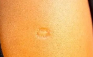 Ako ste i vi rođeni za vreme SFRJ, onda sigurno imate ovaj ožiljak na ruci. Znate li od čega?