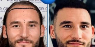 Gudelj uradio transplataciju kose i izgleda 10 godina mlađe! Evo ko je još zbog ćelavosti išao kod doktora – šok