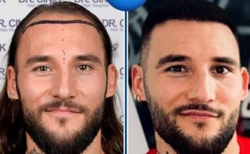 Gudelj uradio transplataciju kose i izgleda 10 godina mlađe! Evo ko je još zbog ćelavosti išao kod doktora – šok