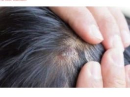 BUBULJICE NA GLAVI SU SVE ČEŠĆI PROBLEM: Ni slučajno ih ne istiskujte, evo zašto se javljaju I ŠTA TREBATE URADITI DA NESTANU