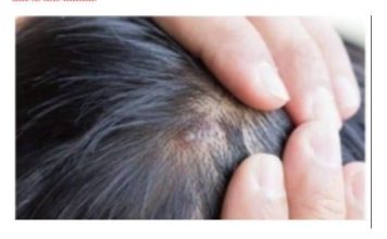 BUBULJICE NA GLAVI SU SVE ČEŠĆI PROBLEM: Ni slučajno ih ne istiskujte, evo zašto se javljaju I ŠTA TREBATE URADITI DA NESTANU