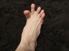 DA LI VAM SE GRČE PRSTI NA STOPALIMA? Evo na šta vas to upozorava, može biti znak većih problema