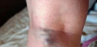 NAMIRNICE KOJE POVEĆAVAJU RIZIK OD TROMBOZE, JEDNA POSEBNO: Jedemo ih svakoga dana, a štete arterijama