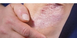 NE BACAJTE NI SLUČAJNO KORU OD OVE VOĆKE: Liječi Psorijazu, Skida Bradavice I Izbjeljuje Zube!