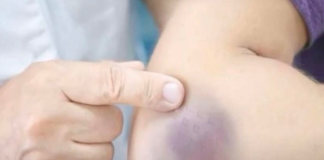 NIKAD NE BISTE POGODILI ZAŠTO SE MODRICE JAVLJAJU PO TIJELU: Nema veze sa POVREDAMA, PRAVI RAZLOGĆE VAS ŠOKIRATI