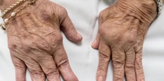 Jedan od glavnih uzroka reume nalazi se u ovoj namirnici: Sadrži opasnu bakteriju koja ubrzava ovu bolest