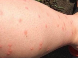 KOMARCI VAM PRAVE PAKAO OD ŽIVOTA? Samo isijecite OVO VOĆE na pola i ostavite u sobi, VIŠE IH NIKADA NEĆETE VIDJETI BLIZU!