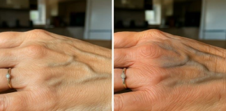 VENE SU VAM ISPUPČENE? 8 razloga zašto se to događa I KADA TREBATE POTRAŽITI DOKTORA!