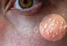 AK0 SU VAM SE P0JAVILE MALE BIJELE TAČKICE EVO NA KOJI NAČIN ĆETE IH SE RIJEŠITI