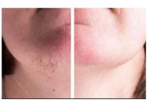 DLAČICE S LICA nestaju kao rukom odnesene: Sve žene širom svijeta potpuno su poludile za ovim receptom!