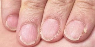 MUČE VAS UMOR, TANKA KOSA I LOMLJIVI NOKTI, EVO ŠTA VAM NEDOSTAJE U ISHRANI