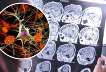 OVO su simptomi demencije koji se javljaju puno prije gubitka pamćenja