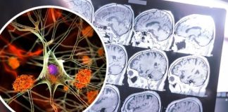 OVO su simptomi demencije koji se javljaju puno prije gubitka pamćenja