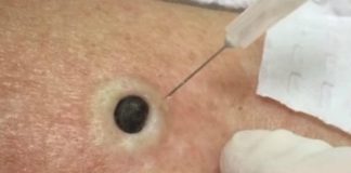 ŽENA JE GAJILA OVO NA LEĐIMA: Kada je doktorka uzela špric i bocnula, shvatit ćete zašto je SNIMAK pregledalo 33 miliona ljudi!