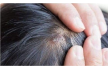 BUBULJICE NA GLAVI SU SVE ČEŠĆI PROBLEM: Ni slučajno ih ne istiskujte, evo zašto se javljaju I ŠTA TREBATE URADITI DA NESTANU