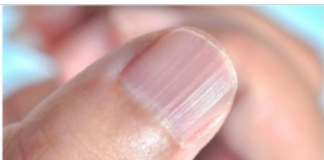 IMATE LI OVAKVE IZBOČINE NA NOKTIMA – evo šta one znače: Doktorica otkrila i možda ćete se iznenaditi