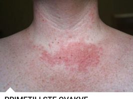 Promene na koži: Doktor otkriva šta se dešava sa vama Promene na koži: Doktor otkriva šta se dešava sa vama - featured image