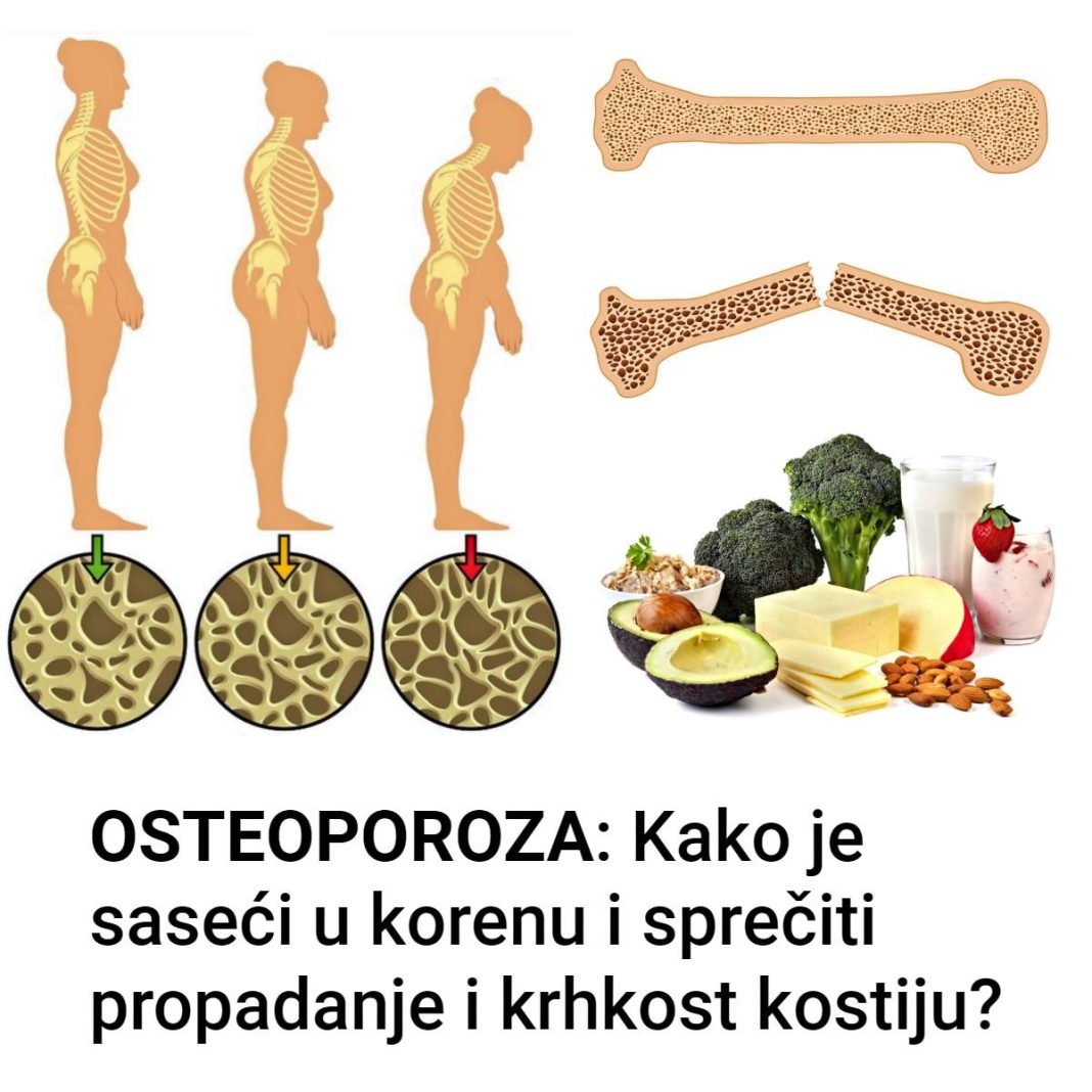Osteoporoza kostiju simptomi i prirodno lečenje - featured image