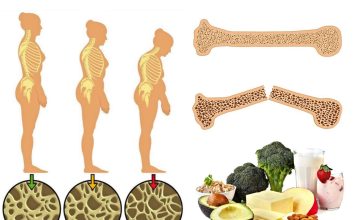 Osteoporoza kostiju simptomi i prirodno lečenje Osteoporoza kostiju simptomi i prirodno lečenje - featured image