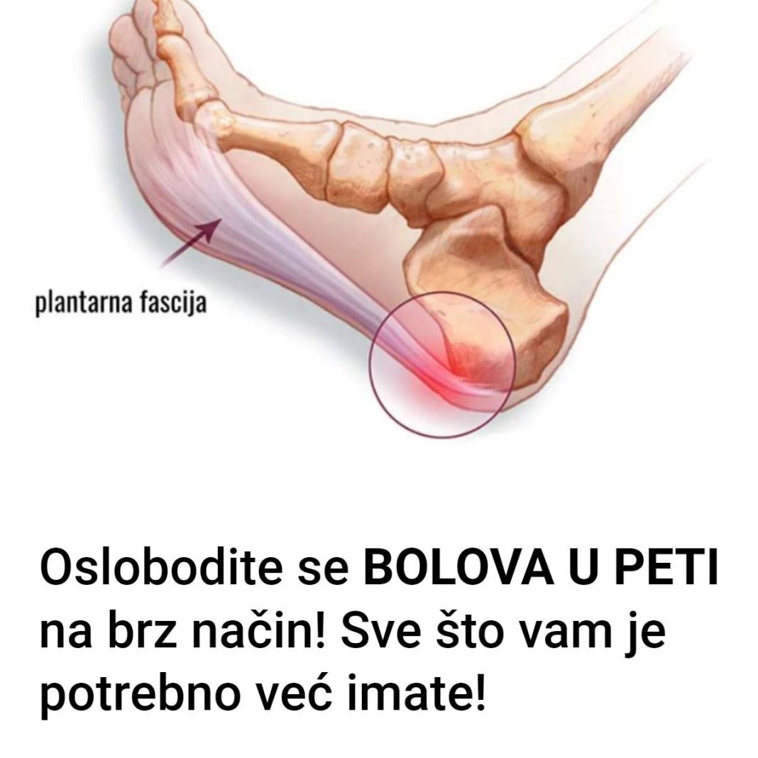 Oslobodite se bolova u peti na brz način! Kako razbiti petni trn? Metoda za ublažavanja boli - featured image Oslobodite se bolova u peti na brz način! Kako razbiti petni trn? Metoda za ublažavanja boli - featured image
