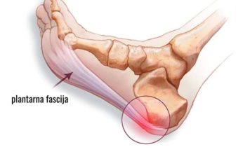 Oslobodite se bolova u peti na brz način! Kako razbiti petni trn? Metoda za ublažavanja boli Oslobodite se bolova u peti na brz način! Kako razbiti petni trn? Metoda za ublažavanja boli - featured image