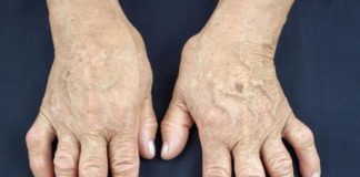 Jedan od glavnih uzroka reume nalazi se u ovoj namirnici: Sadrži opasnu bakteriju koja ubrzava ovu bolest Jedan od glavnih uzroka reume nalazi se u ovoj namirnici: Sadrži opasnu bakteriju koja ubrzava ovu bolest - featured image