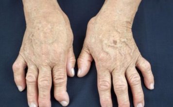 Jedan od glavnih uzroka reume nalazi se u ovoj namirnici: Sadrži opasnu bakteriju koja ubrzava ovu bolest Jedan od glavnih uzroka reume nalazi se u ovoj namirnici: Sadrži opasnu bakteriju koja ubrzava ovu bolest - featured image