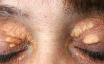 STAVILA SAM OVU NAMIRNICU NA MASNO TKIVO KOD OKA, ono je preko noći nestalo: EVO ŠTA ME SPASILO, SVI GA IMATE U KUĆI