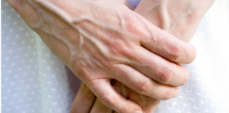 VENE SU VAM ISPUPČENE? 8 razloga zašto se to događa I KADA TREBATE POTRAŽITI DOKTORA!