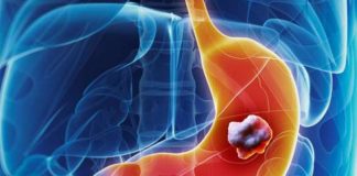 5 ranih simptoma raka želuca: Tumor može da raste godinama, a svi pacijenti prvo osjete ovo 5 ranih simptoma raka želuca: Tumor može da raste godinama, a svi pacijenti prvo osjete ovo - featured image