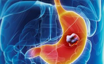 5 ranih simptoma raka želuca: Tumor može da raste godinama, a svi pacijenti prvo osjete ovo 5 ranih simptoma raka želuca: Tumor može da raste godinama, a svi pacijenti prvo osjete ovo - featured image