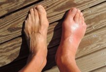 7 namirnica koje potiho stvaraju mokraćnu kiselinu i uništavaju vaše zglobove 7 namirnica koje potiho stvaraju mokraćnu kiselinu i uništavaju vaše zglobove - featured image