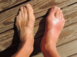 7 namirnica koje potiho stvaraju mokraćnu kiselinu i uništavaju vaše zglobove 7 namirnica koje potiho stvaraju mokraćnu kiselinu i uništavaju vaše zglobove - featured image