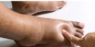 Recept za Najbolji Prirodni ČAJ Na Svijetu Za Uklanjanje 0TEKLINA! Recept za Najbolji Prirodni ČAJ Na Svijetu Za Uklanjanje 0TEKLINA! - featured image