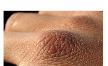 Puca vam koža, opada kosa ili imate grčeve? Tijelo vam govori da vam nedostaju ovi vitamini Puca vam koža, opada kosa ili imate grčeve? Tijelo vam govori da vam nedostaju ovi vitamini - featured image