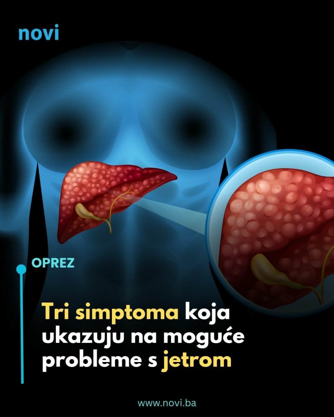 Ovo su 3 simptoma koja ukazuju na moguće probleme s jetrom - featured image Ovo su 3 simptoma koja ukazuju na moguće probleme s jetrom - featured image