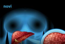 Ovo su 3 simptoma koja ukazuju na moguće probleme s jetrom Ovo su 3 simptoma koja ukazuju na moguće probleme s jetrom - featured image