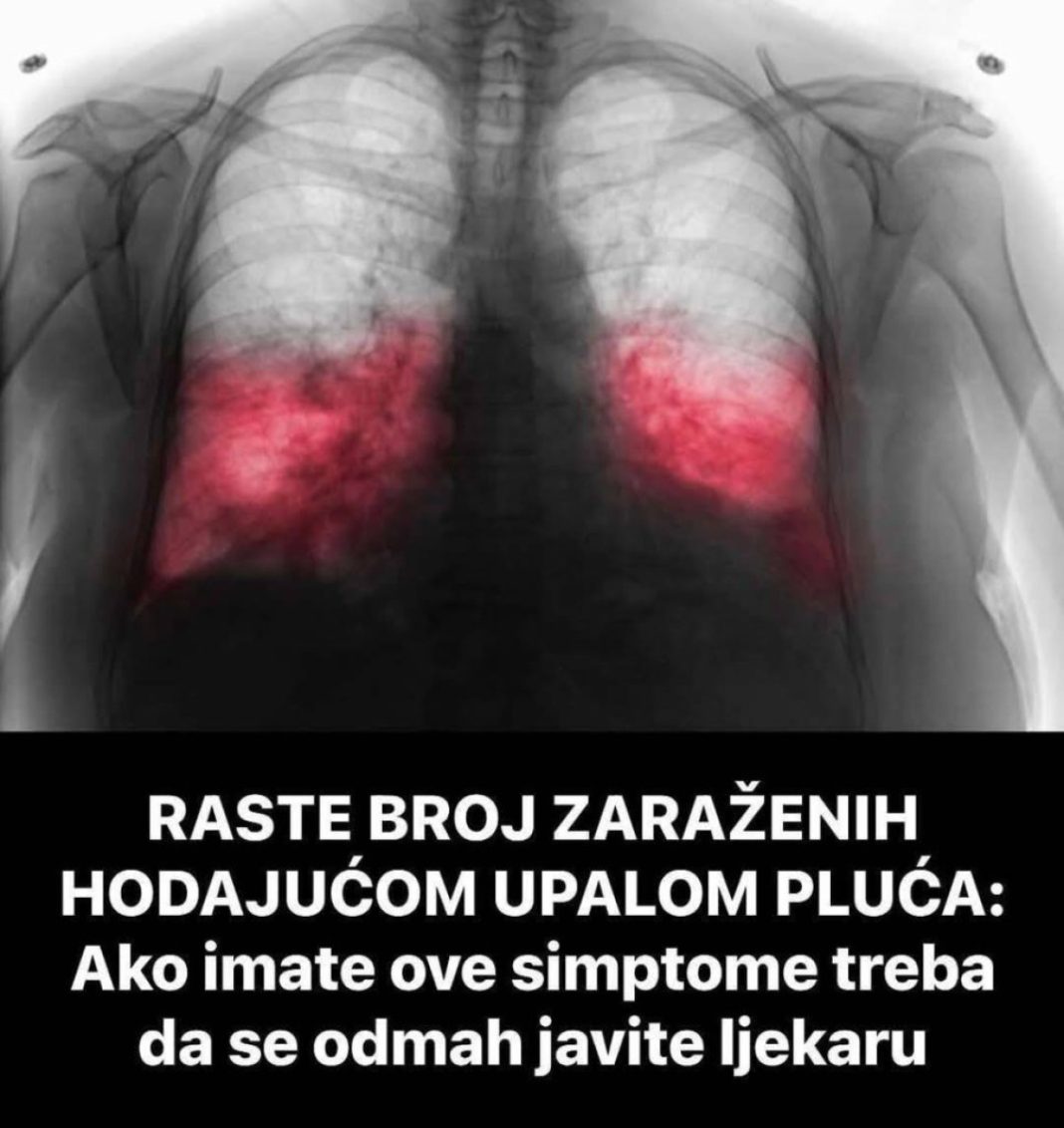 VELlKl BR0J ZARAŽENIH H0DAJUĆ0M UPALOM PLUĆA: Ako imate ove simptome 0DMAH SE JAVlTE D0KT0RU… - featured image VELlKl BR0J ZARAŽENIH H0DAJUĆ0M UPALOM PLUĆA: Ako imate ove simptome 0DMAH SE JAVlTE D0KT0RU… - featured image
